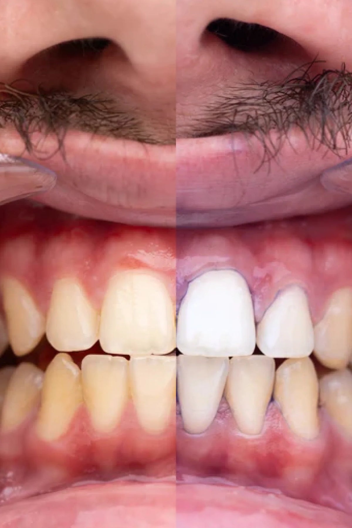🦷 Blanqueador Dental Morada v34 🔥