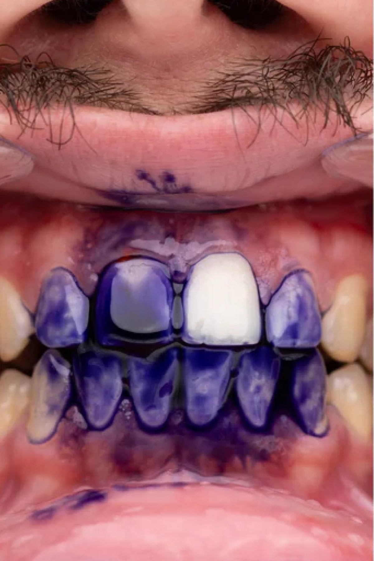 🦷 Blanqueador Dental Morada v34 🔥